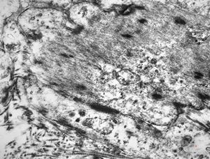 M,52y. | myofibroblastic tumor - pleura M,52y. | myofibroblastic tumor - pleura